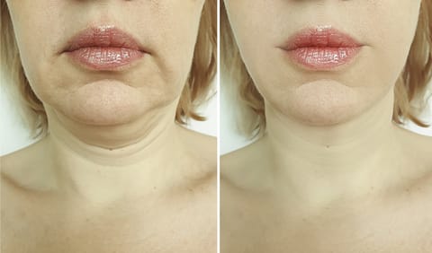 Neck & Face Lifting LED Therapy Device