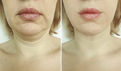 Neck & Face Lifting LED Therapy Device